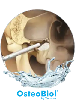 Praxisklinik Bartsch - OsteoBiol - Kieferknochenaufbau zur Vorbereitung auf den Zahnersatz