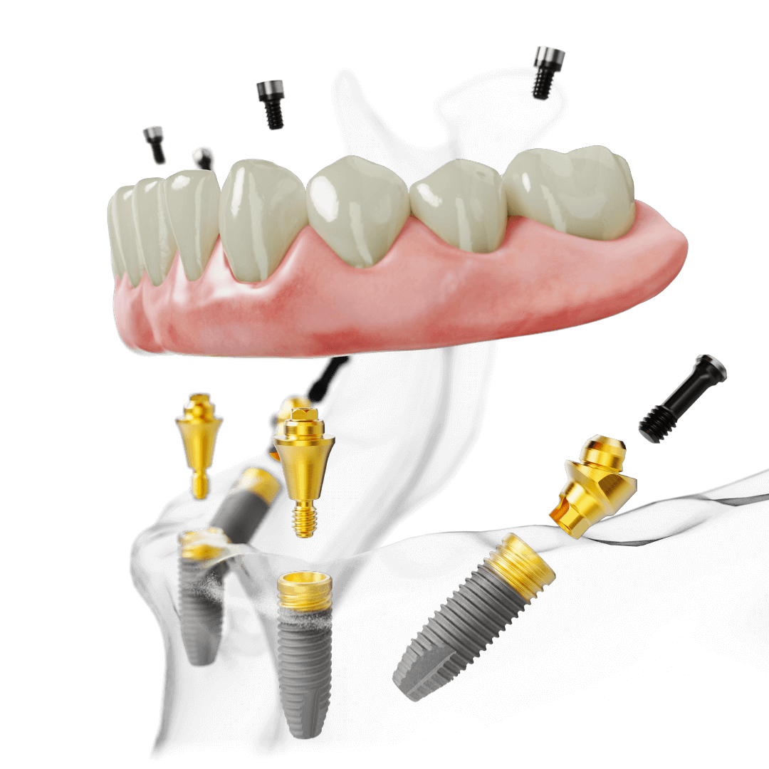 All-on-4 Unterkiefer