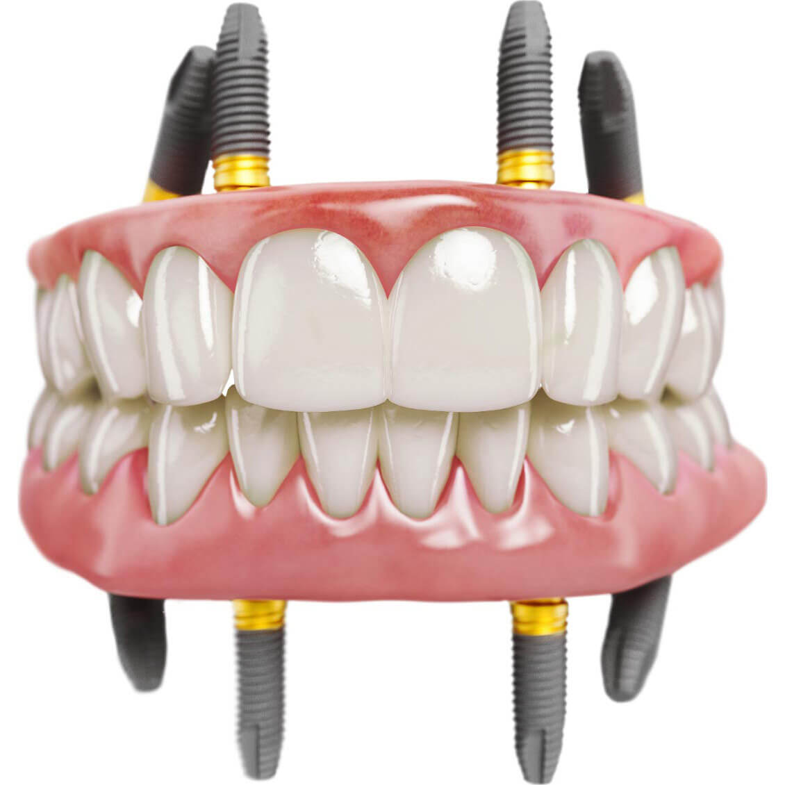 All-on-4 Frontansicht